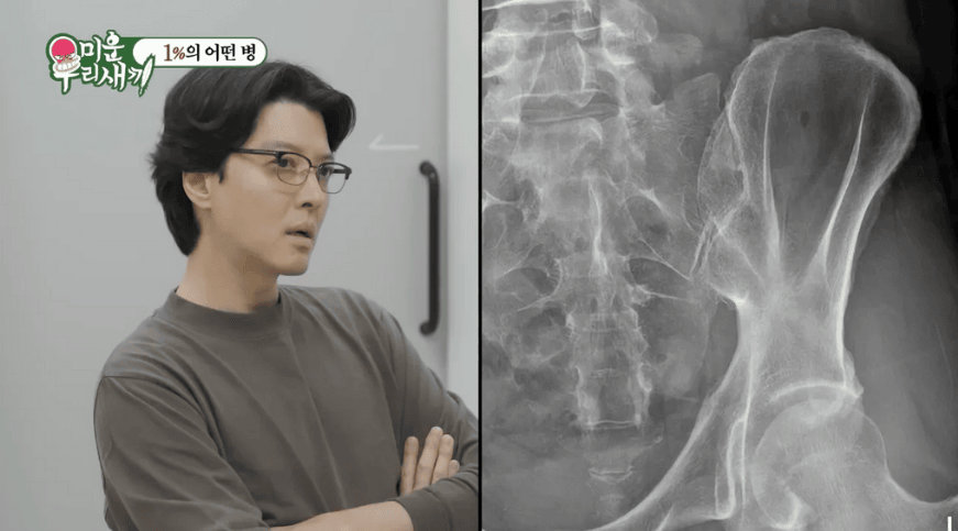 Aktor Lee Dong-gun berdiri di samping gambar hasil Rontgen (X-ray) panggul yang menunjukkan peradangan sendi sacroiliac, terkait diagnosis ankylosing spondylitis.